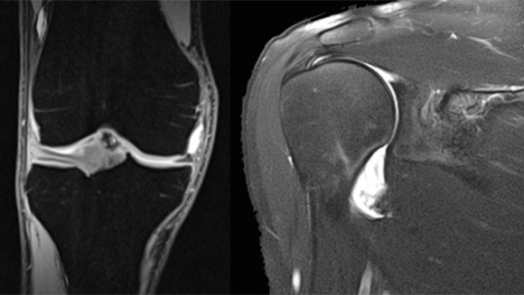 Arthro-IRM arthro-rim